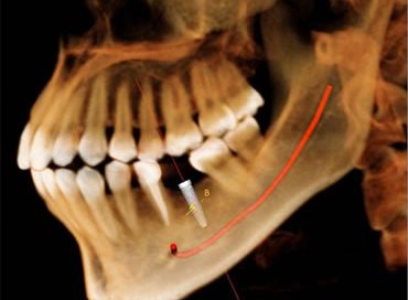 Dental implants Charlottesville