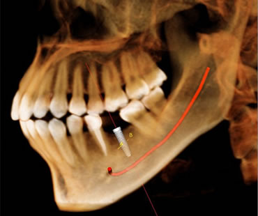 Dental implants Charlottesville